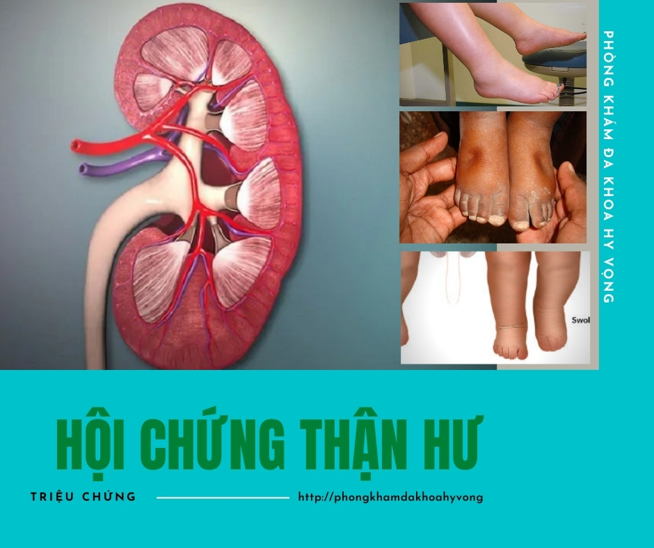 Hội chứng thận hư: Chẩn đoán và điều trị